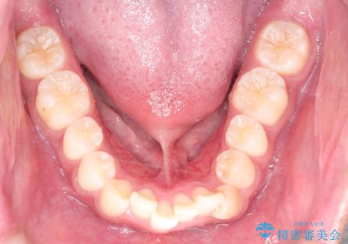 インビザラインによる出っ歯の矯正の治療前