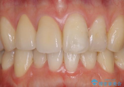 前歯2本の着色が気になる、、、セラミック治療の症例 治療後