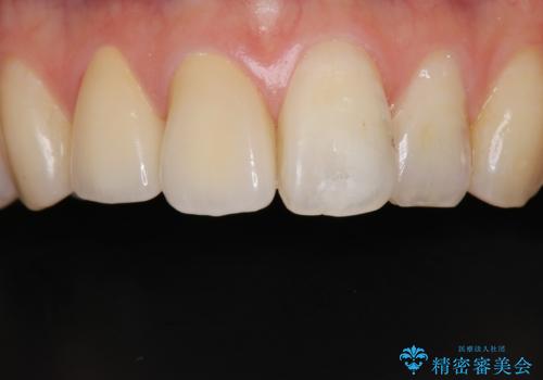 前歯2本の着色が気になる、、、セラミック治療の治療後
