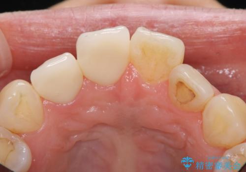 前歯2本の着色が気になる、、、セラミック治療の治療後