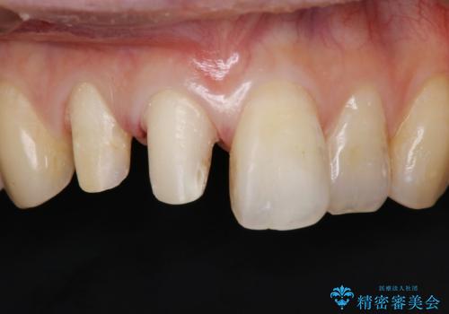前歯2本の着色が気になる、、、セラミック治療の治療中