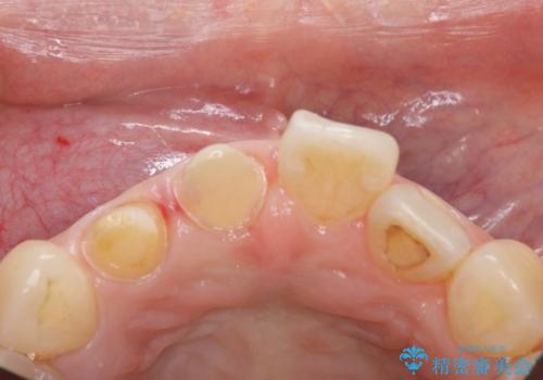 前歯2本の着色が気になる、、、セラミック治療の治療前