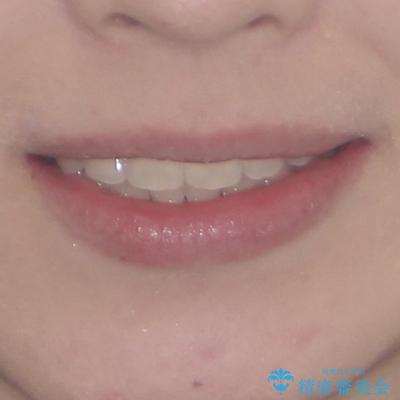 インビザラインが続けられない　ワイヤー矯正での抜歯矯正　その2の治療後（顔貌）