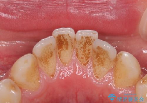 ステイン除去で印象が明るくの治療前