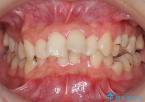 【難症例】歯並びが悪く、虫歯の治療ができない 矯正治療からスタートの治療前