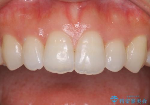 久しぶりのホワイトニングの治療前