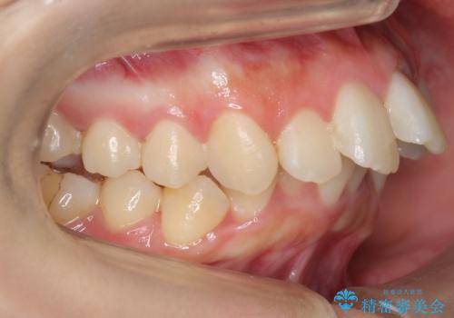 【難症例】歯並びが悪く、虫歯の治療ができない 矯正治療からスタートの治療前