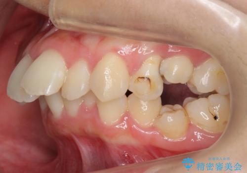 【難症例】歯並びが悪く、虫歯の治療ができない　矯正治療からスタートの症例 治療前