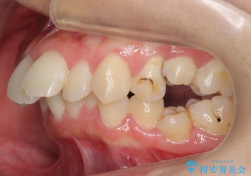 【難症例】歯並びが悪く、虫歯の治療ができない　矯正治療からスタート