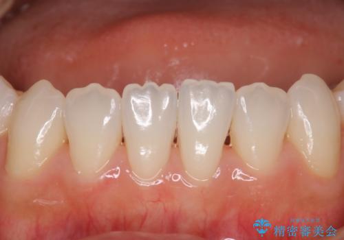 久しぶりのホワイトニングの治療前