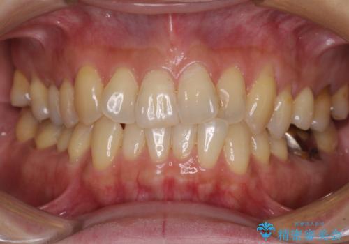 リスク回避 ワイヤー矯正を併用したインビザライン矯正治療の治療前