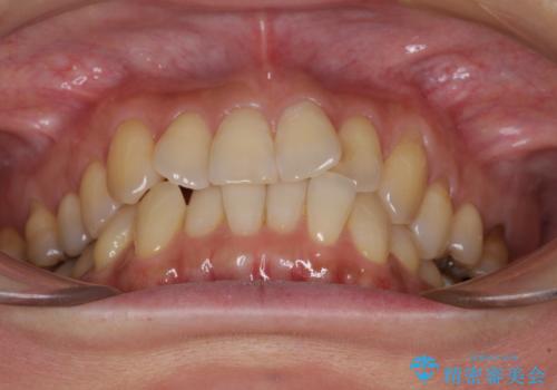 リスク回避 ワイヤー矯正を併用したインビザライン矯正治療の治療前