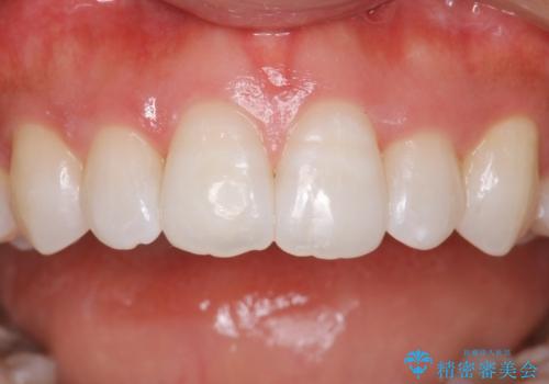 久しぶりのホワイトニング