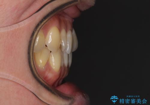 リスク回避 ワイヤー矯正を併用したインビザライン矯正治療の治療前