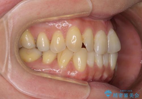 リスク回避 ワイヤー矯正を併用したインビザライン矯正治療の治療前