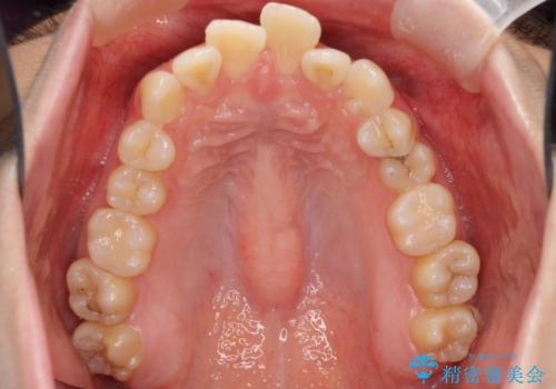【難症例】歯並びが悪く、虫歯の治療ができない 矯正治療からスタートの治療前