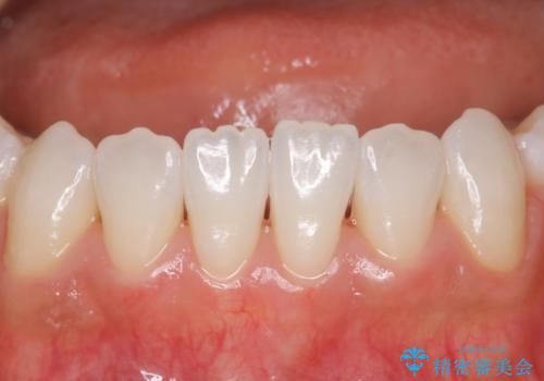 久しぶりのホワイトニングの治療後