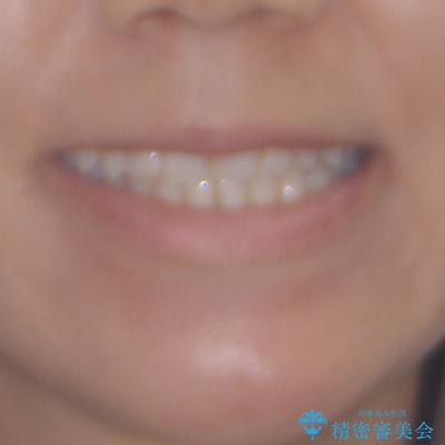 オープンバイトによる見た目を治したい インビザラインでの矯正治療の治療後(顔貌)