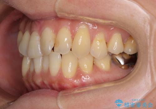 リスク回避 ワイヤー矯正を併用したインビザライン矯正治療の治療前