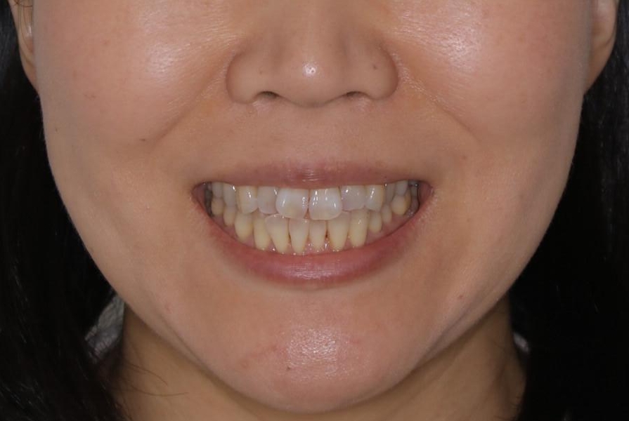 歯ぐき、骨が薄い方のマウスピース矯正治療　非抜歯でもIPR(歯を削る処置)で口元に変化をの治療前（顔貌）