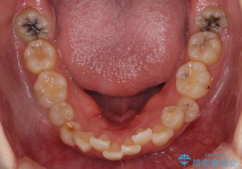 【難症例】歯並びが悪く、虫歯の治療ができない　矯正治療からスタートの治療前