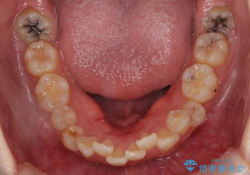 【難症例】歯並びが悪く、虫歯の治療ができない 矯正治療からスタートの治療前