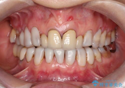 【オールセラミッククラウン】前歯を綺麗にしたい。の症例 治療前