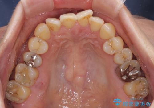 リスク回避 ワイヤー矯正を併用したインビザライン矯正治療の治療前