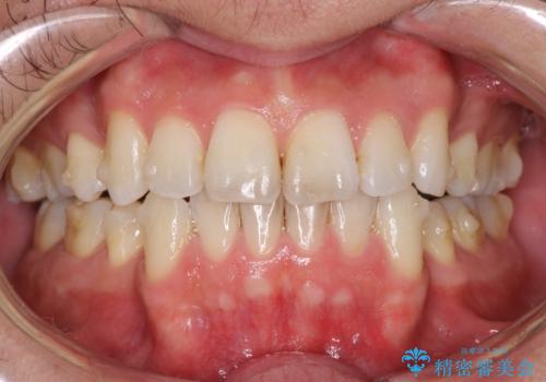 矯正中のオフィスホワイトニング