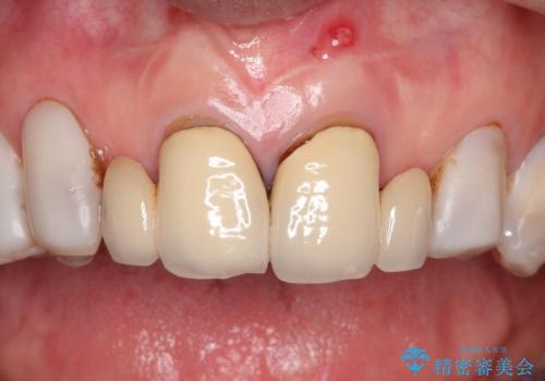 【オールセラミッククラウン】前歯を綺麗にしたい。の治療前