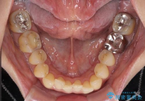 リスク回避 ワイヤー矯正を併用したインビザライン矯正治療の治療前