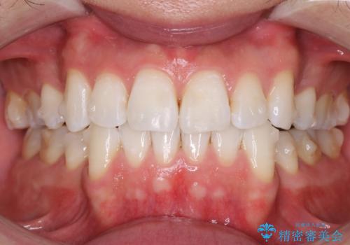 矯正中のオフィスホワイトニングの治療後