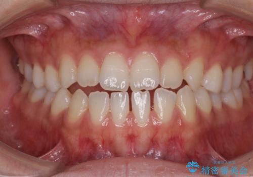舌突出癖で口元が開いてしまう 舌トレーニングを行ったインビザライン矯正の症例 治療前