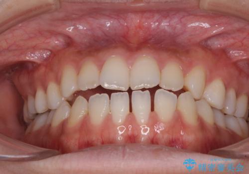 舌突出癖で口元が開いてしまう 舌トレーニングを行ったインビザライン矯正の治療前