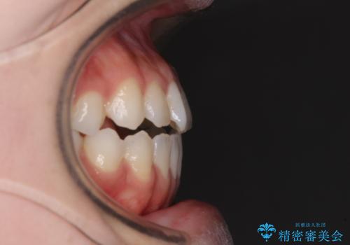 舌突出癖で口元が開いてしまう 舌トレーニングを行ったインビザライン矯正の治療前