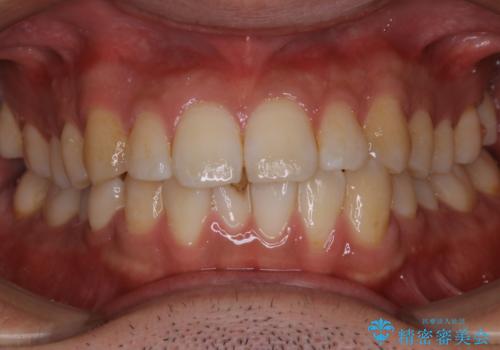 コーヒーの着色が前歯について目立つの治療前