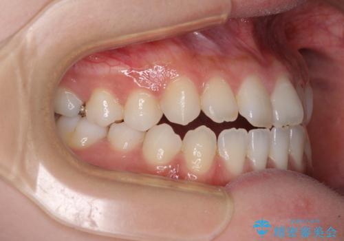 舌突出癖で口元が開いてしまう 舌トレーニングを行ったインビザライン矯正の治療前