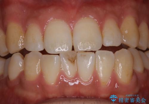 コーヒーの着色が前歯について目立つの治療前