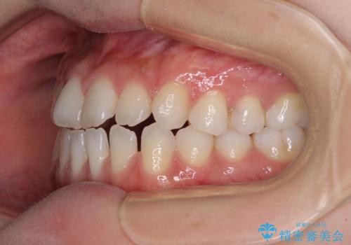 舌突出癖で口元が開いてしまう 舌トレーニングを行ったインビザライン矯正の治療前