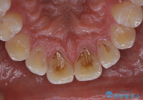 コーヒーの着色が前歯について目立つの治療前