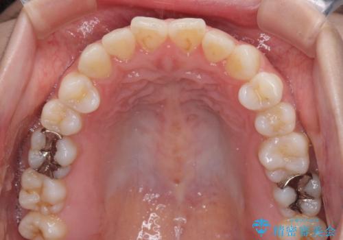 舌突出癖で口元が開いてしまう 舌トレーニングを行ったインビザライン矯正の治療前