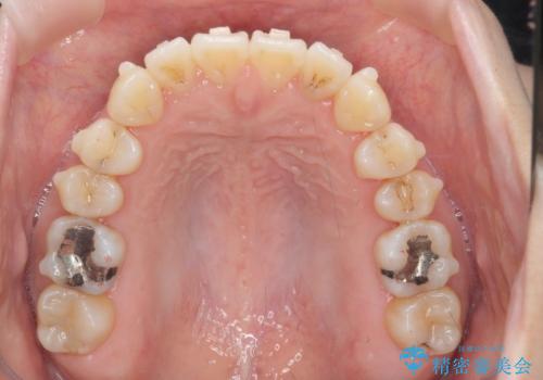 [ マウスピース矯正 ]  出っ歯を改善したいの治療中