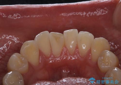 コーヒーの着色が前歯について目立つの治療前