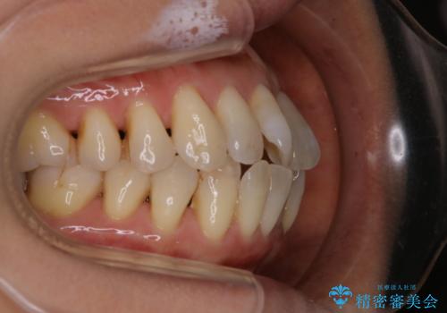 歯ぐき、骨が薄い方のマウスピース矯正治療　非抜歯でもIPR(歯を削る処置)で口元に変化をの治療前
