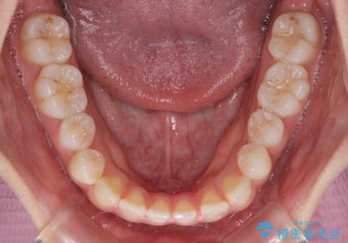 舌突出癖で口元が開いてしまう　舌トレーニングを行ったインビザライン矯正の治療前
