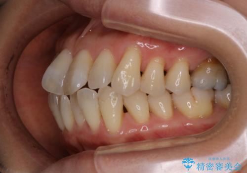 歯ぐき、骨が薄い方のマウスピース矯正治療 非抜歯でもIPR(歯を削る処置)で口元に変化をの治療前