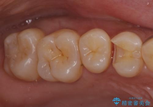奥歯の虫歯 セラミックインレーで治療の治療中