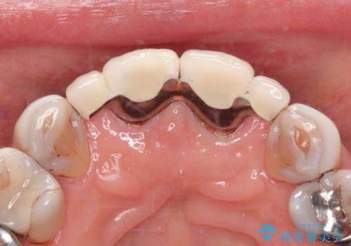 【オールセラミッククラウン】前歯を綺麗にしたい。の治療前