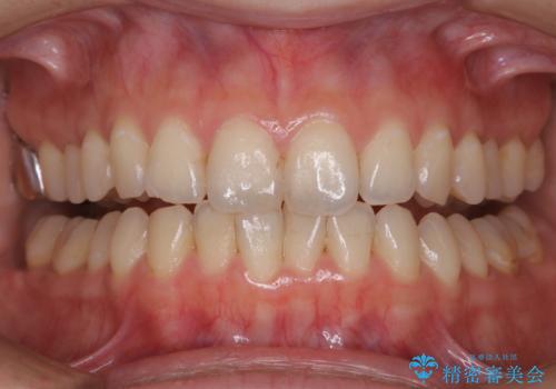 オフィスホワイトニングのエクセレントコースの治療前