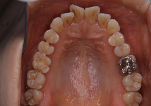 歯ぐき、骨が薄い方のマウスピース矯正治療 非抜歯でもIPR(歯を削る処置)で口元に変化をの治療前